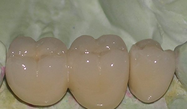 metal_porcelana metal_porcelana